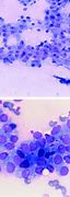 Image result for Carcinoid Cytology