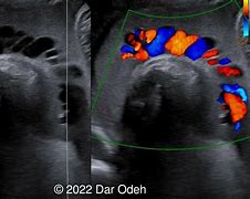 Image result for Echogenic Amniotic Fluid Ultrasound
