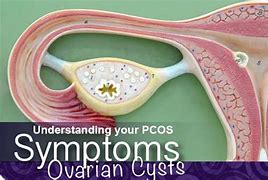 Image result for 12 Cm Cyst On Ovary