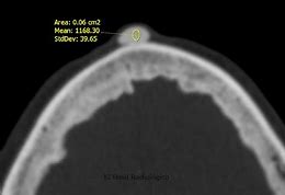 Image result for Sebaceous Cyst Scalp CT