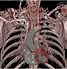 Image result for Subclavian Artery CT