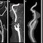 Image result for What Is Carotid Artery Dissection