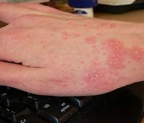 Image result for Scabies Head