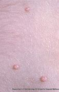 Image result for Molluscum Bumps Removal