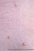 Image result for Moscullum Contagiosum