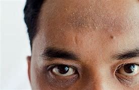 Image result for Eczema On Black Skin Face