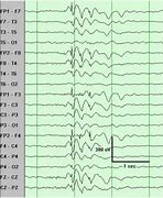 Image result for Multiple Spikes EEG