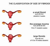 Image result for 4 Cm Fibroid