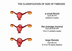 Image result for 2 5 Cm Fibroid