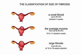 Image result for Fibroids in Uterus Size