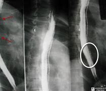 Image result for Candida Esophagitis