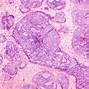 Image result for How Big Is an 8 Cm Tumor Image