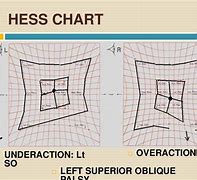 Image result for Hess Screen Chart