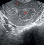 Image result for USG Uterus and Adnexa