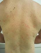 Image result for Identifying Skin Rashes Children