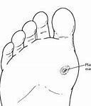 Image result for Cutting Out Plantar Wart