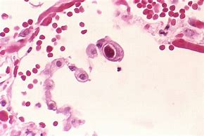 Image result for Cytomegalovirus