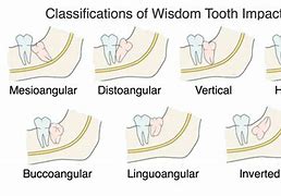 Image result for Wisdom Teeth Growing Sideways