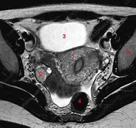 Image result for Normal Ovary MRI