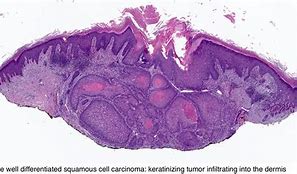 Image result for Squamous Cell Carcinoma of the Skin Histopathology