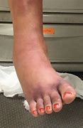 Image result for Broken Foot Bruising