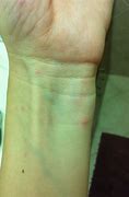 Image result for Pictures of Skin Rashes On Wrist