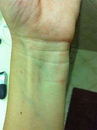 Image result for Rash On Wrist
