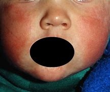 Image result for Fifth Disease Stages