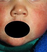 Image result for Fifth Disease