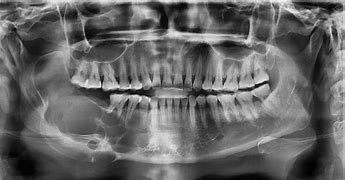 Image result for Show Pic of Jaw Bone Cancer