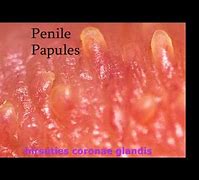 Image result for Hirsuties Papillaris Genitalis