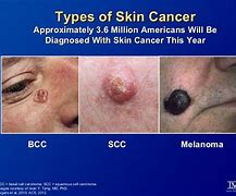 Image result for Basal Cell vs Melanoma