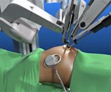 Image result for Robotic Gallbladder Surgery