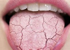 Image result for Candidiasis Bucal