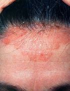 Image result for Scabies in Hair and Scalp