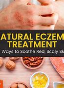 Image result for eczema home remedy