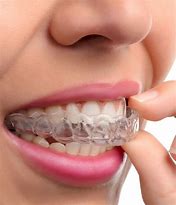 Image result for Vertical Overbite