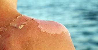 Image result for SunBurn Skin Peel