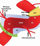 Image result for Carotid Sinus Stenosis