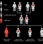 Image result for Sickle Cell Anemia Trait Symptoms