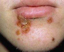 Image result for Red Rash around Mouth
