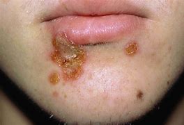 Image result for Rash around the Mouth in Adults