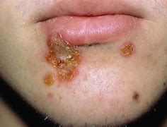 Image result for Impetigo Skin Disease
