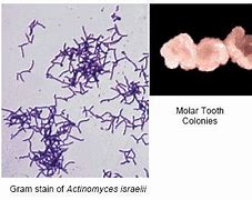 Image result for actinomicoxis