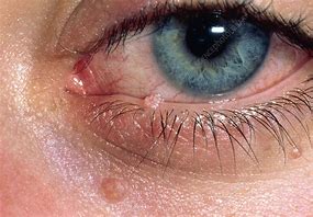 Image result for +Molluscum Contagiosum Treatment Eye Lids