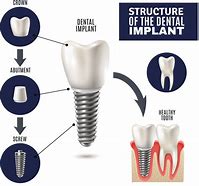 Image result for Implant Flat Screw Placement