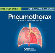 Image result for Pneumothorax Thoracic Vent