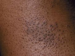 Image result for Eczema Brown Skin