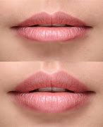 Image result for Lip Fillers
