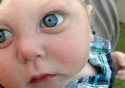 Image result for Baby Boy Born with Anencephaly